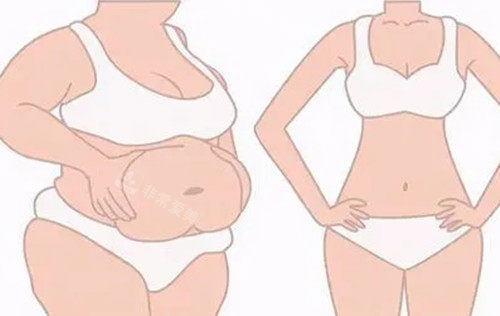 全身吸脂前后对比示意图 全身吸脂前后对比示意图