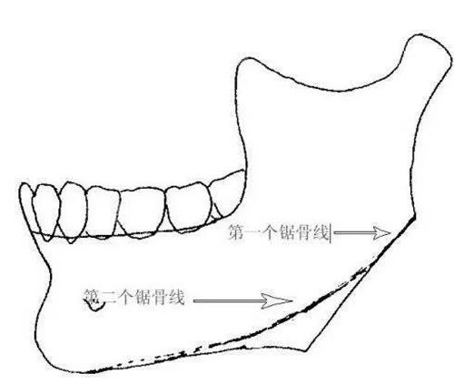 下颌骨截骨出现二次角示意图 下颌骨截骨出现二次角示意图