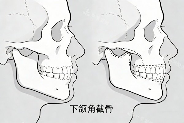 下颌角截骨卡通图展示 下颌角截骨卡通图展示