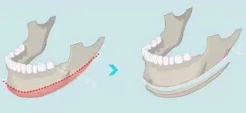 下颌角长曲线截骨前后对比 下颌角长曲线截骨前后对比