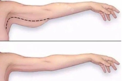 拜拜肉吸脂对比图 拜拜肉吸脂对比图