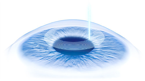 全飞秒近视手术作用区域