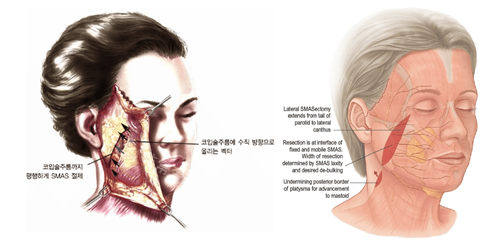北京加减美v9手术原理逐层分离