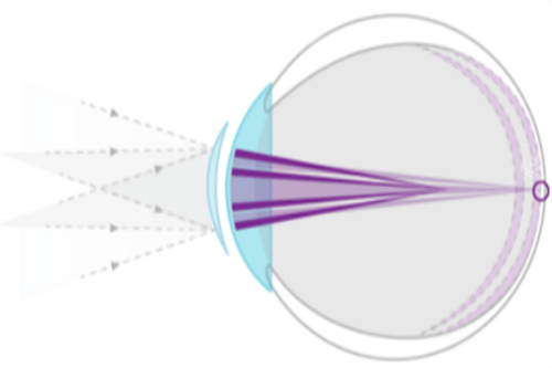 离焦镜片光线示意图