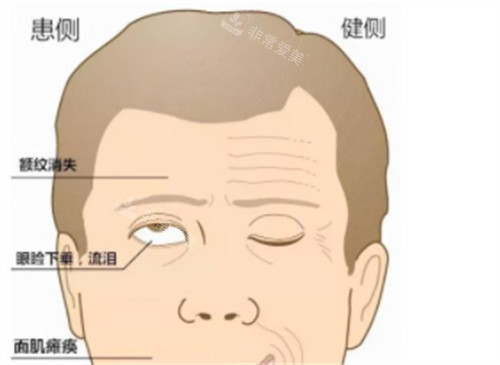 眼睑闭合不全现象