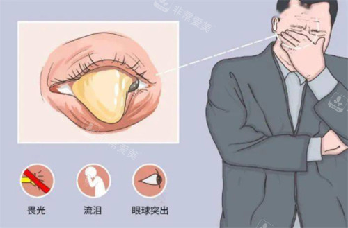 眼睑闭合不全的危害