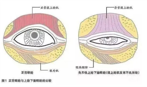眼睑闭合不全的样子