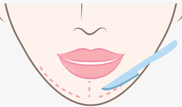 下巴整形手术卡通图