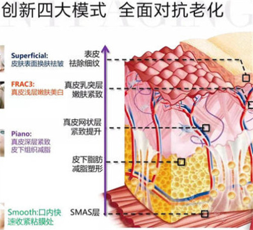 fotona4d欧洲之星不同模式对应层次
