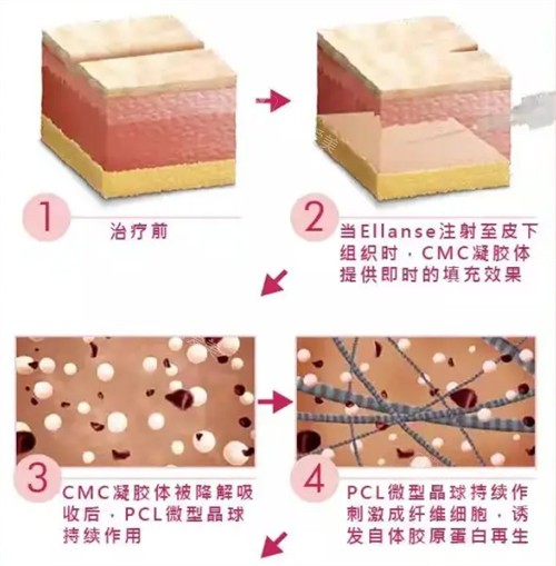 少女针治疗步骤