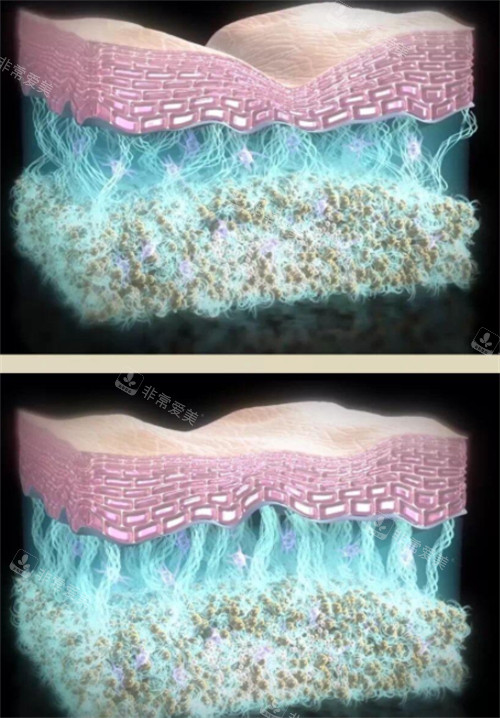 少女针注射前后皮肤变化