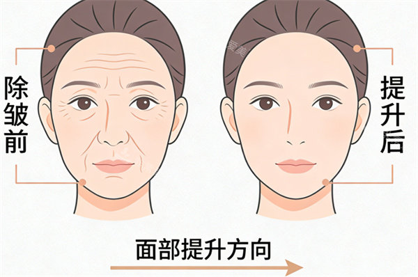 面部提升除皱前后对比 面部提升除皱前后对比