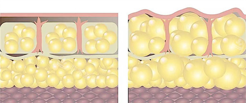 自体脂肪填充前后皮肤层动画图
