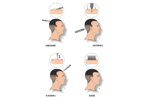 不剃发植发示意图