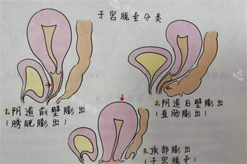 子宫脱垂的不同程度展现