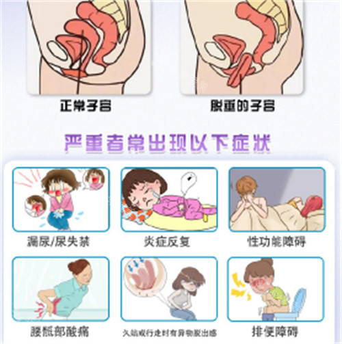 子宫脱垂的症状