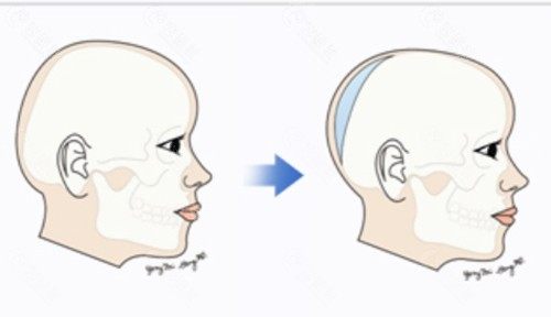 骨水泥填充后脑勺