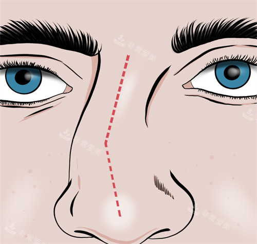 歪鼻对五官不友好