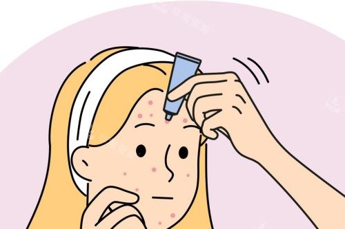 祛痘卡通展示图