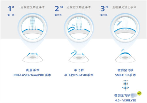 全飞秒4.0技术与其他技术对比