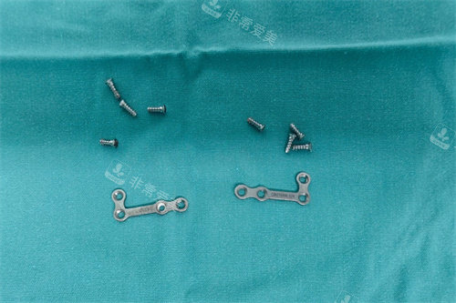 面部轮廓整形固定用的钛钉钛板