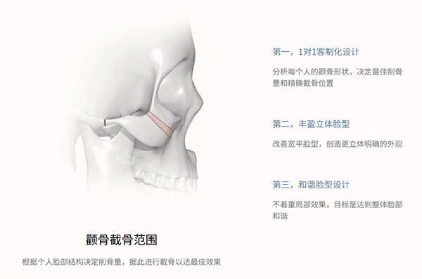 韩国345整形面部轮廓手术