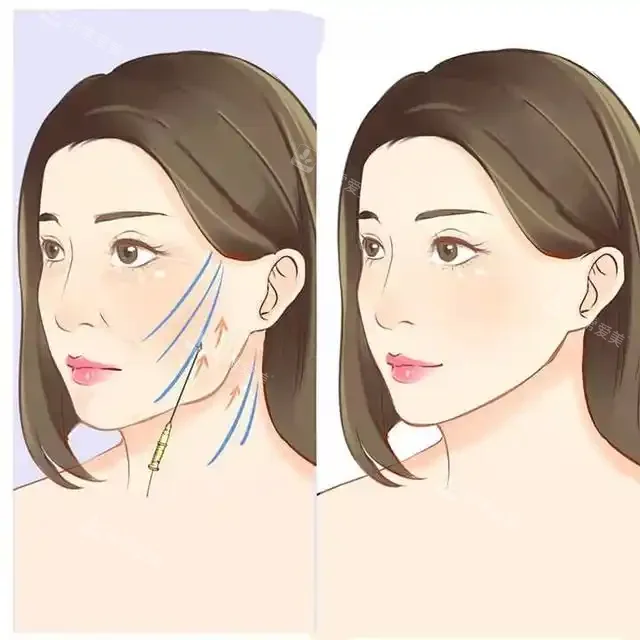 拉皮除皺手術(shù)