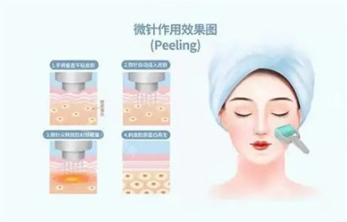 黃金微針作用圖 黃金微針作用圖