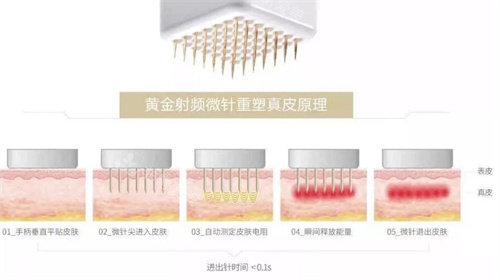 黃金微針原理 黃金微針原理