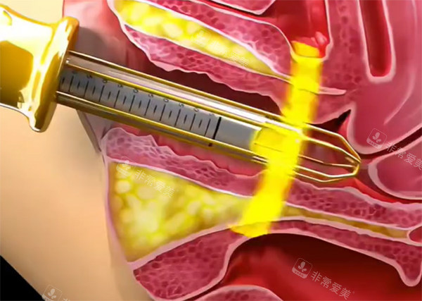 紧缩针紧缩推药照片