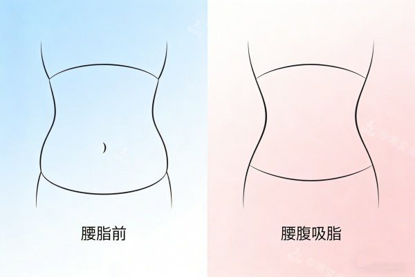 腰腹部做吸脂前后对比展示图