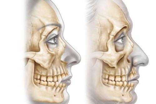 鼻基底整形对比图