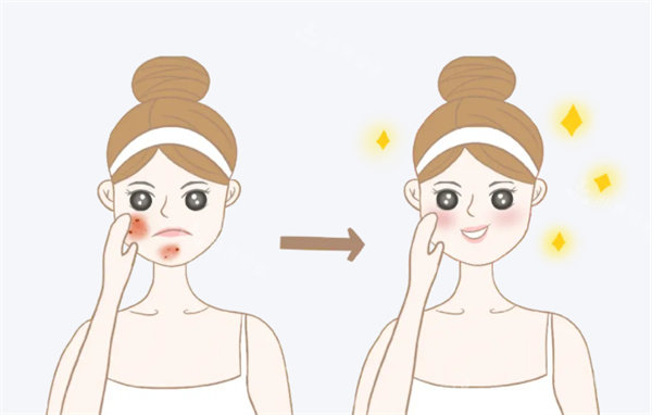 面部祛斑前后对比卡通图