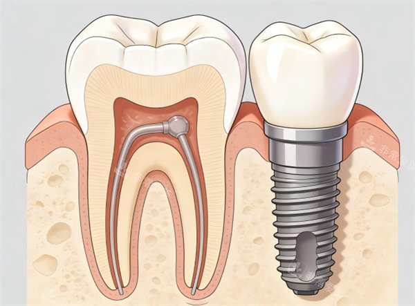 种植牙插画图片展示