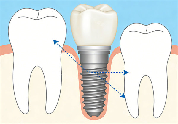 种植牙模型示意图展示