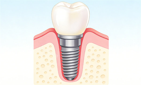 单颗种植牙图片展示