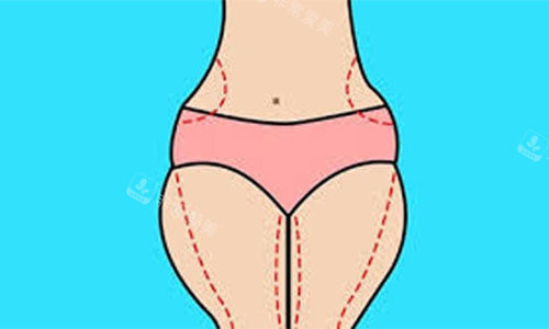 大腿吸脂手術(shù)設(shè)計方案示意圖
