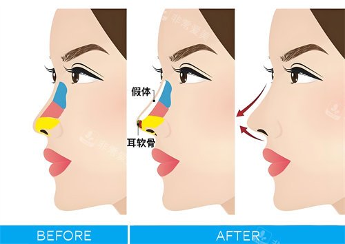 隆鼻手術圖解動畫圖 隆鼻手術圖解動畫圖