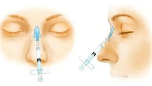 玻尿酸注射隆鼻動(dòng)畫展示圖