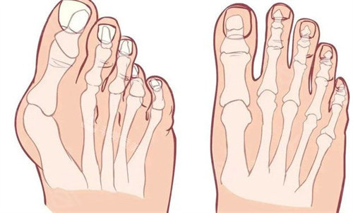 大腳骨的腳和正常對比 大腳骨的腳和正常對比