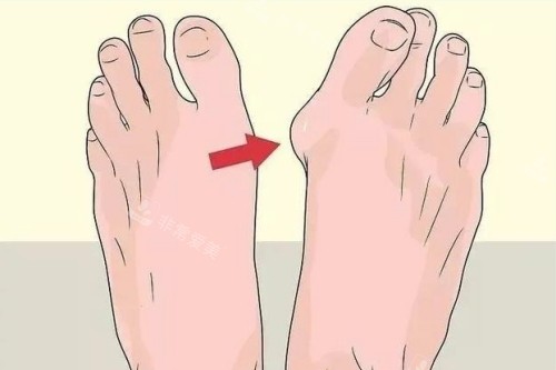 大腳骨整形前后對比圖 大腳骨整形前后對比圖