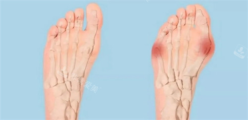 正常腳和大腳骨 正常腳和大腳骨