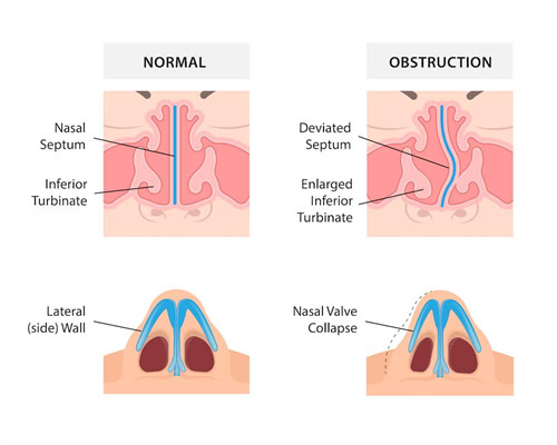 扭曲鼻子的修復(fù)對比圖 扭曲鼻子的修復(fù)對比圖