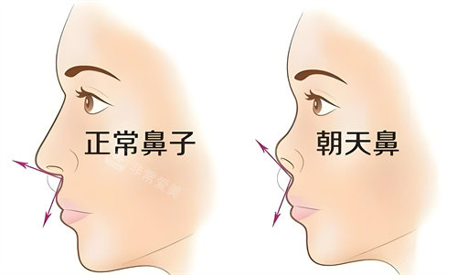 正常鼻子與朝天鼻對比動畫圖 正常鼻子與朝天鼻對比動畫圖