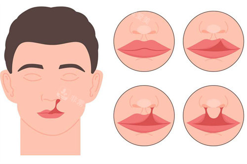 成人唇裂及唇腭裂 成人唇裂及唇腭裂