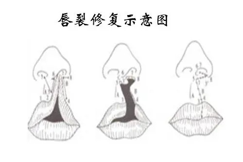 唇裂修復(fù)示意圖.webp 唇裂修復(fù)示意圖.webp