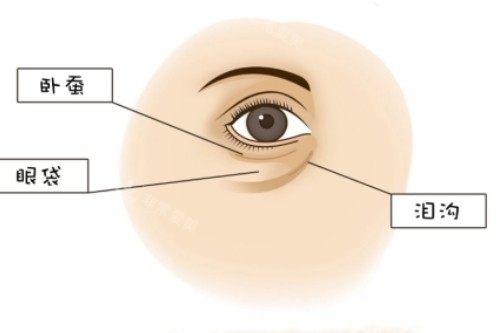 臥蠶、眼袋、淚溝展示圖 臥蠶、眼袋、淚溝展示圖