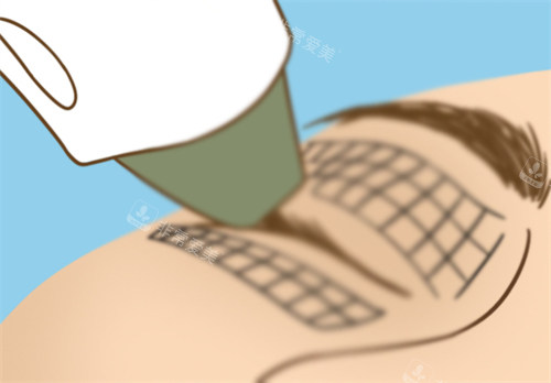 眼部熱瑪吉 眼部熱瑪吉