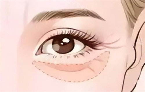 眼部填充膠原蛋白 眼部填充膠原蛋白