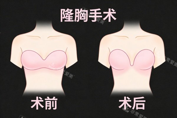 隆胸手術(shù)前后對比圖 隆胸手術(shù)前后對比圖